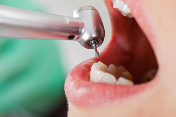 Best Emergency Wisdom Teeth Removal in Johnstown, PA